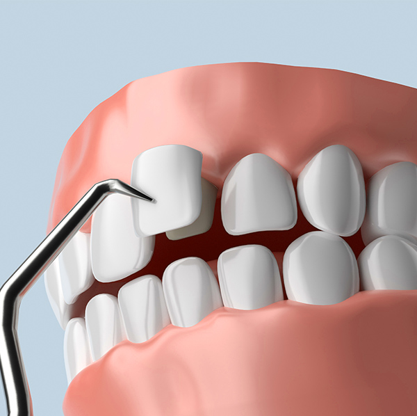 illustration of a porcelain veneer being placed over a front tooth