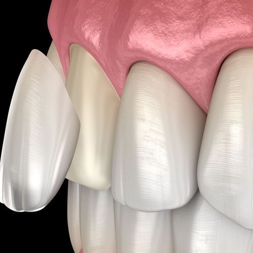 Porcelain veneers