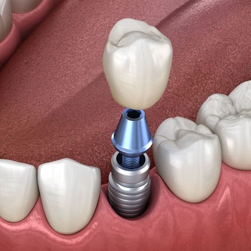 Dental Implants