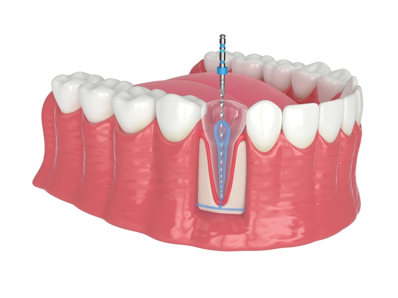 Root canal illustration