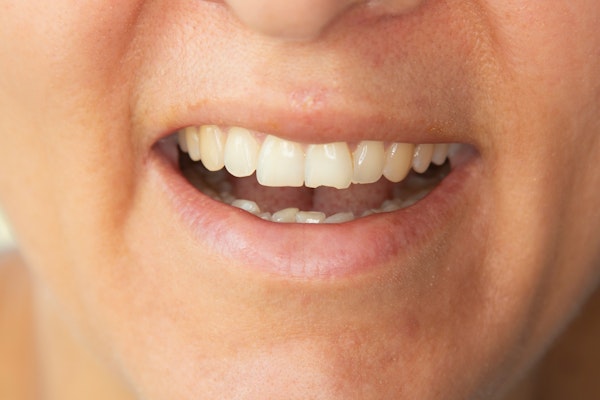 Close-up of a smile with a chipped tooth