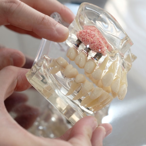 Close-up of a model with dental implants