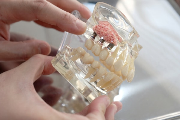 Close-up of a model with dental implants