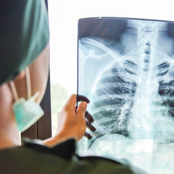 lung x-ray