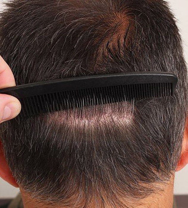 man with barely visible scar from follicular unit transplantation