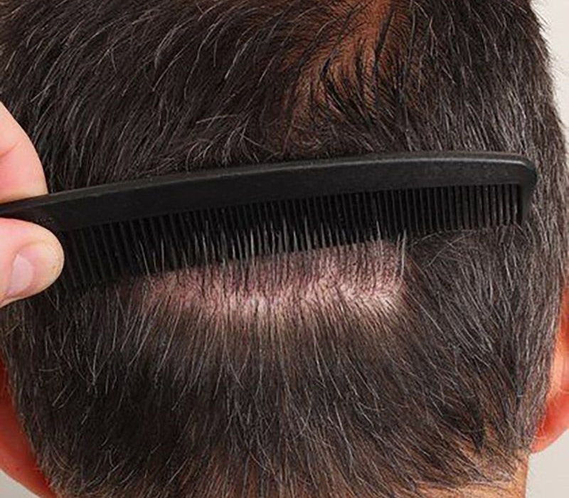 man with barely visible scar from follicular unit transplantation