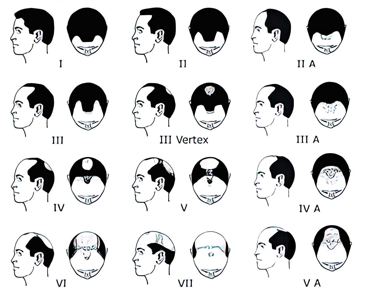7 Stages of Male Pattern Baldness: Male Balding Patterns 101