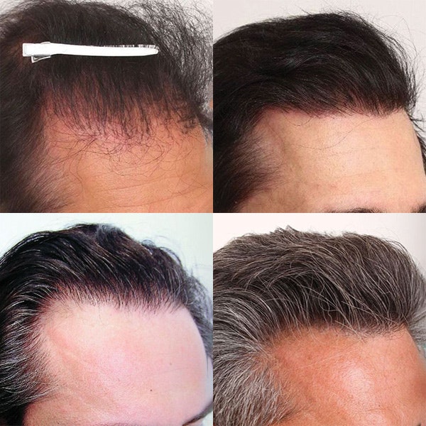 Before and afters of hair transplant repairs