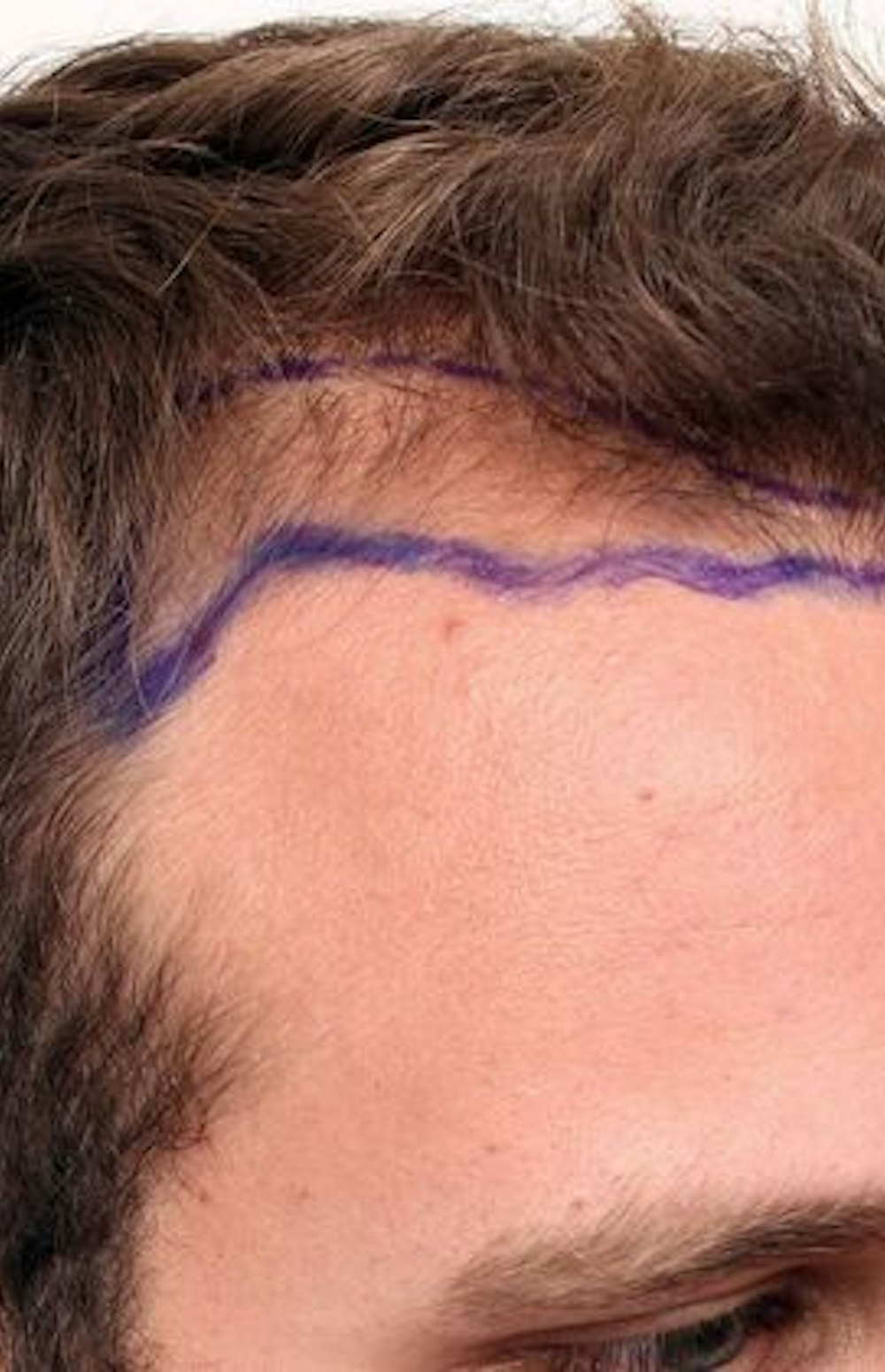 Before FUE