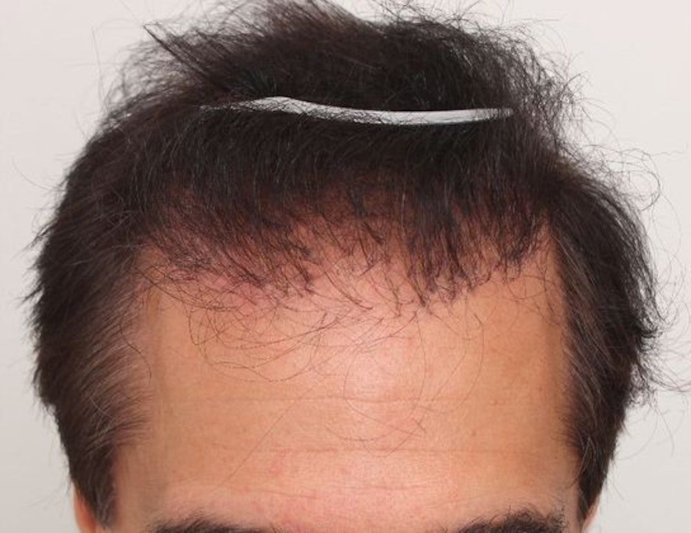 Results after a bad hair transplant