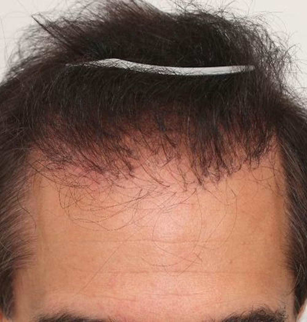 Results after a bad hair transplant