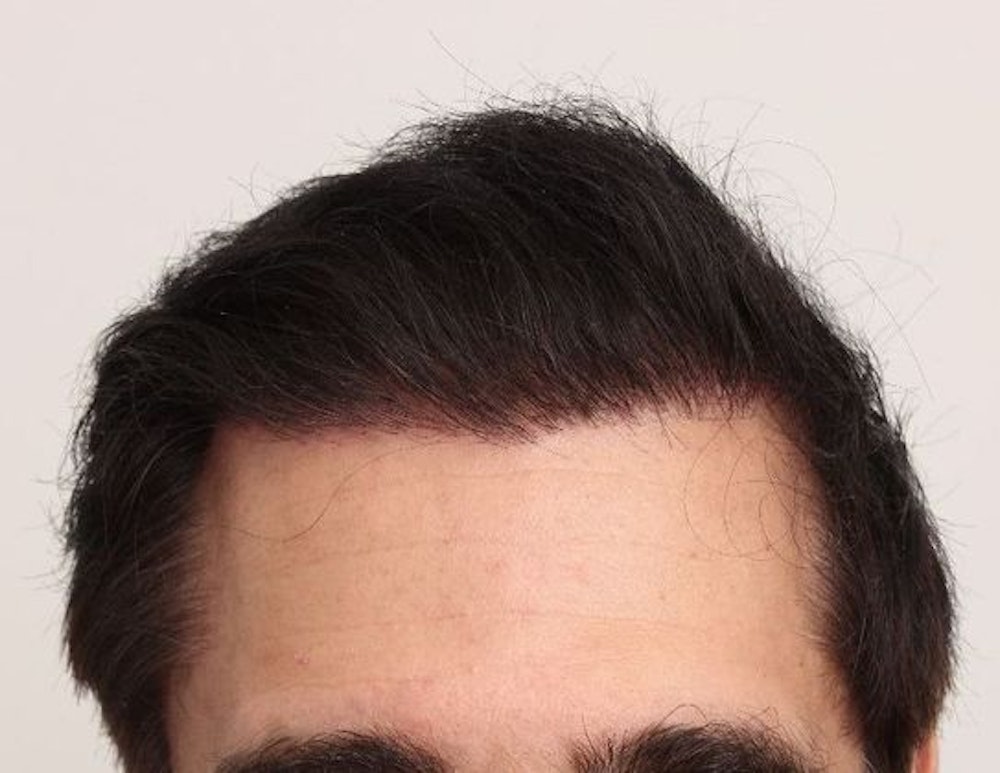 Results after Dr. Dorin corrected the bad hair transplant