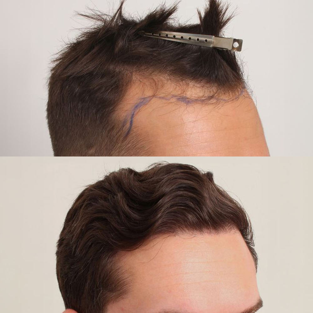 Dr. Robert Dorin's patient before and after Follicular Unit Transplantation (FUT)