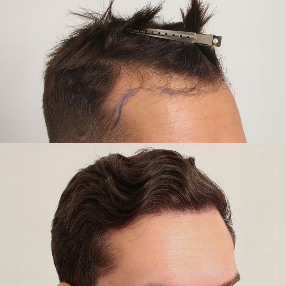 Dr. Robert Dorin's patient before and after Follicular Unit Transplantation (FUT)