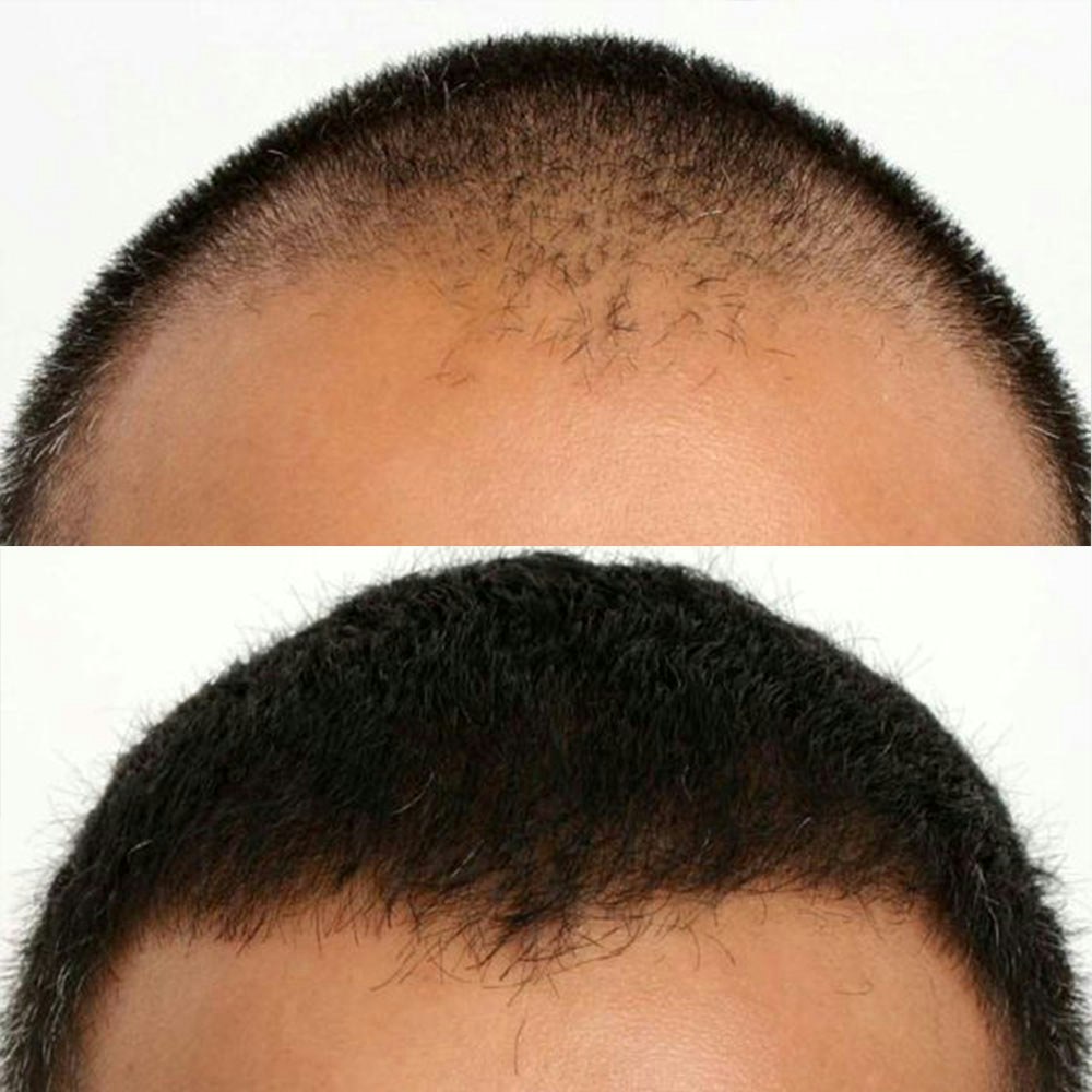 Dr. Robert Dorin's patient before and after Follicular Unit Extraction (FUE)