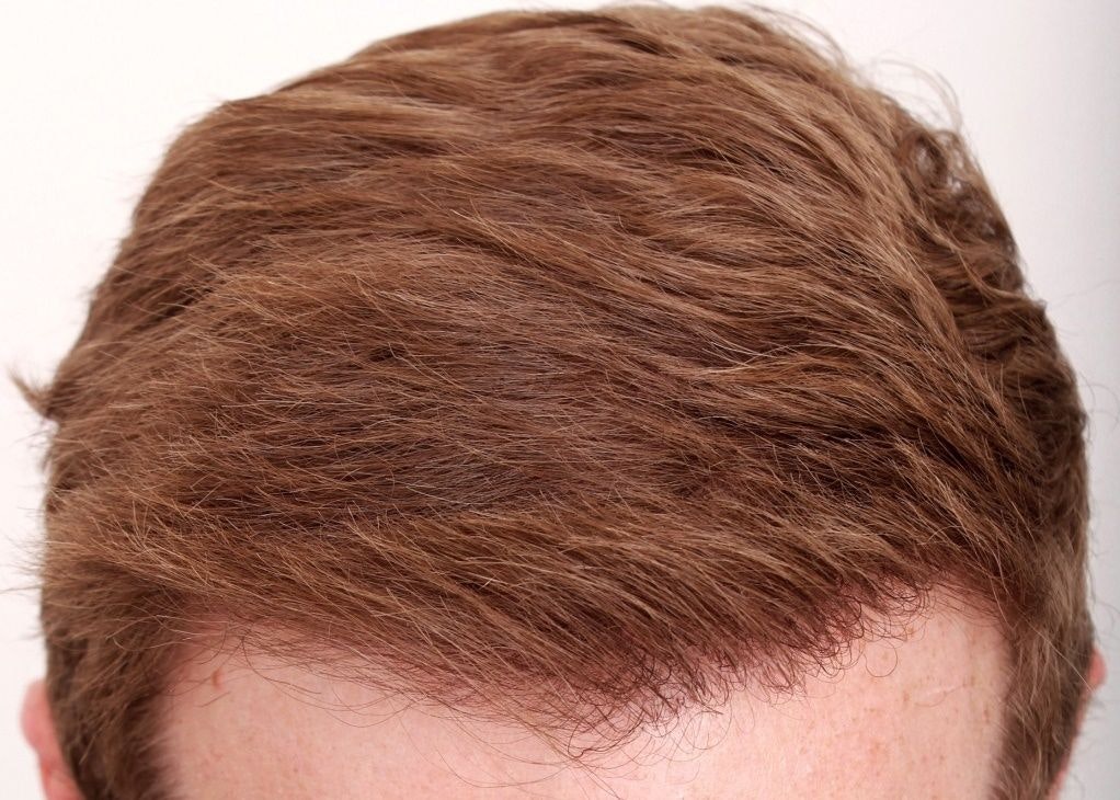 after hair restoration