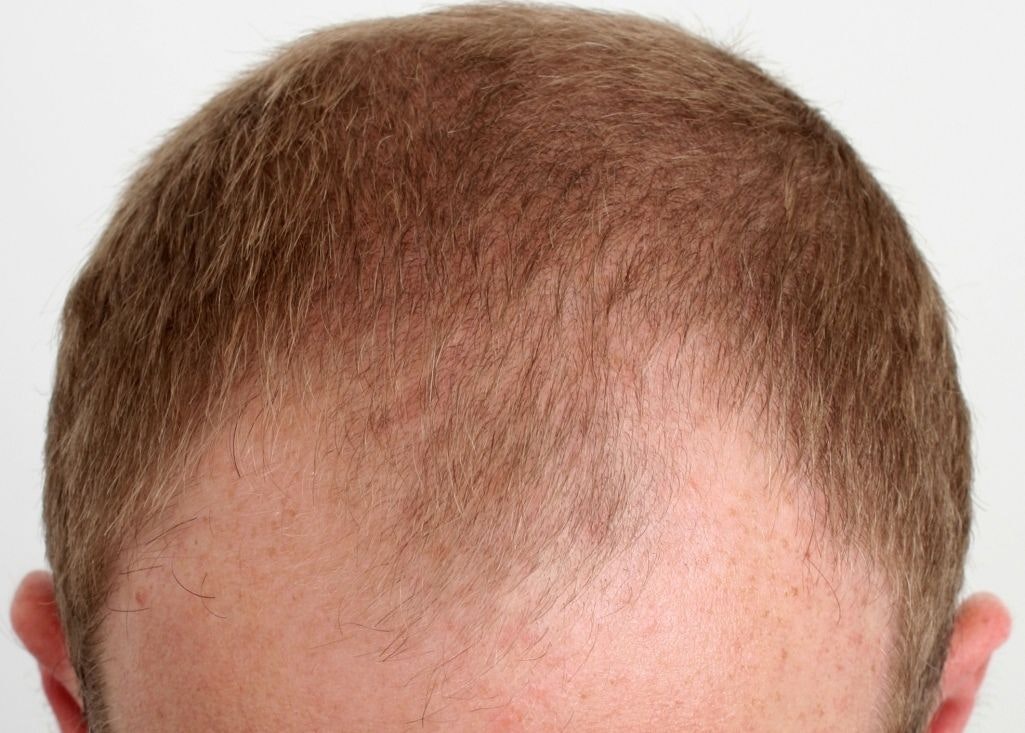 before hair restoration