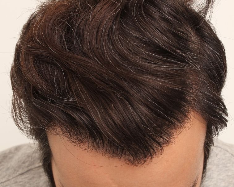 Hair Loss Doctors's patient after hair restoration