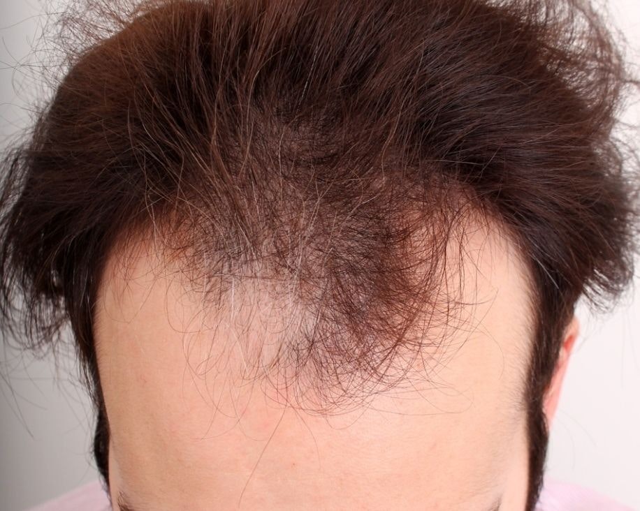Hair Loss Doctors's patient before hair restoration