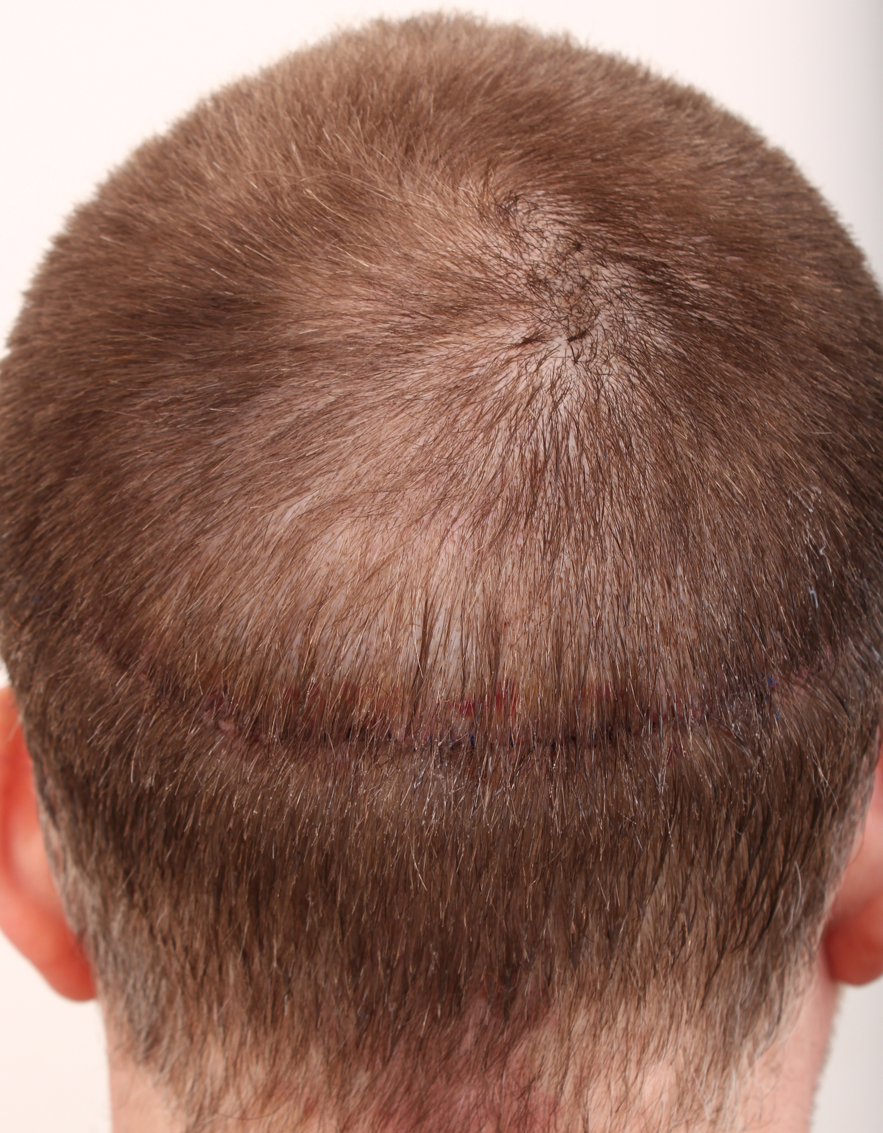 Hair Transplant