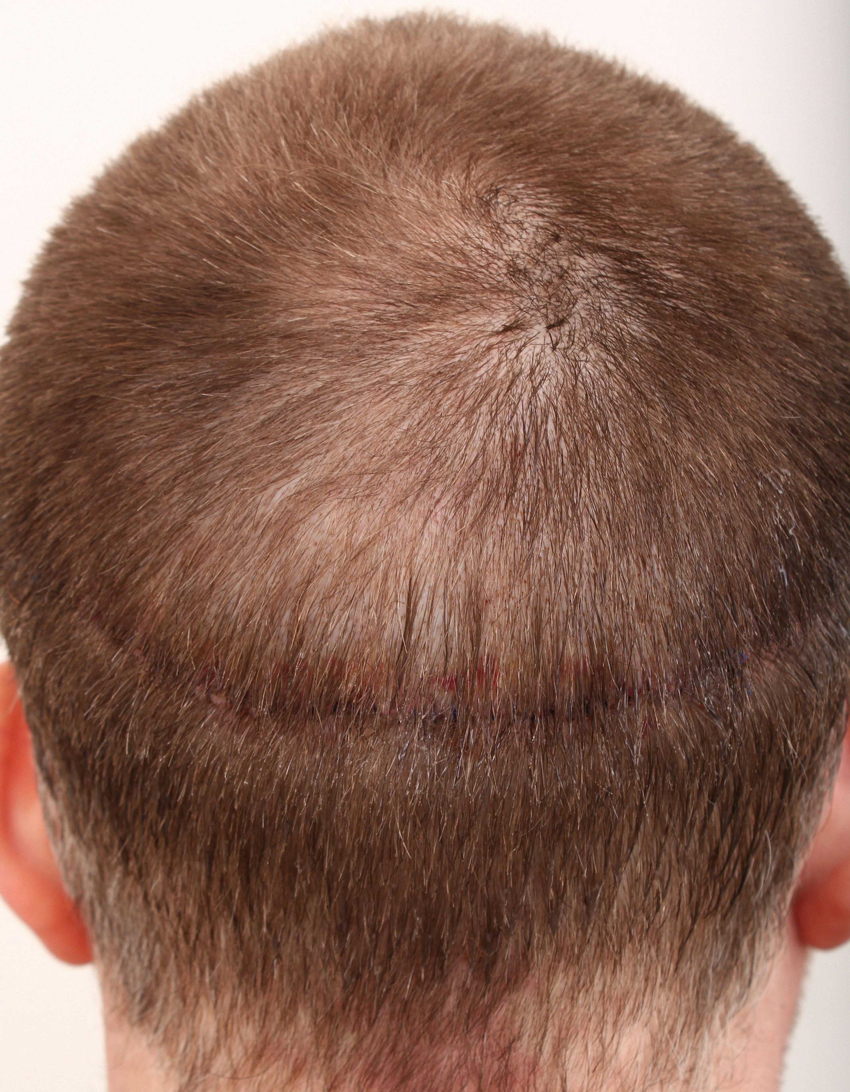 Hair Transplant