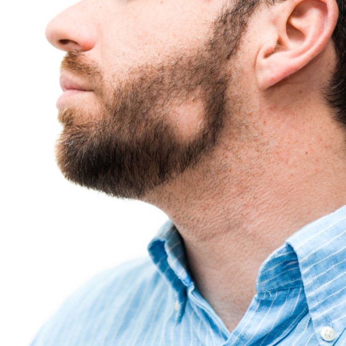 Man with patchy beard