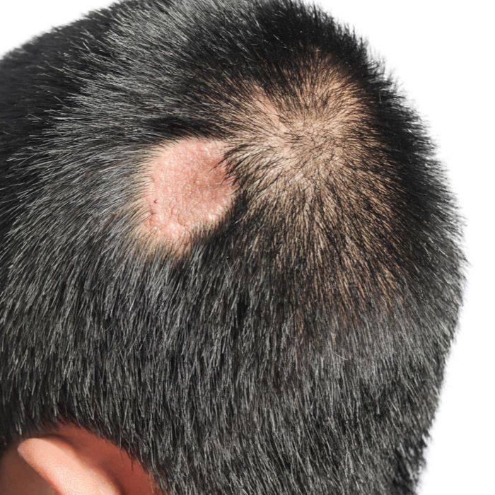 Patient with burn scar on scalp