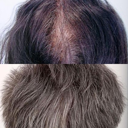 before and after hair restoration