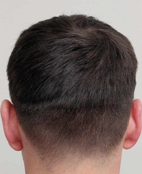 5 Months After FUE: No Scarring