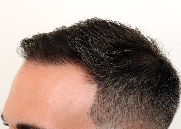 After Hair Restoration