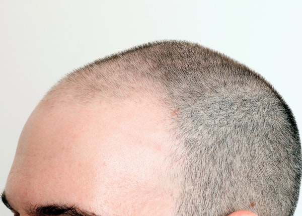 Before Hair Restoration