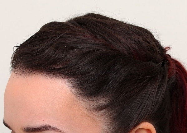 After Hair Restoration