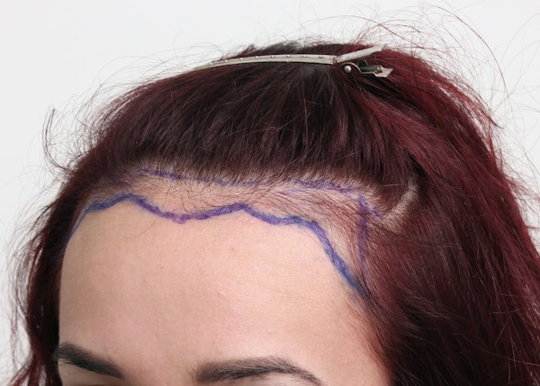 Before Hair Restoration