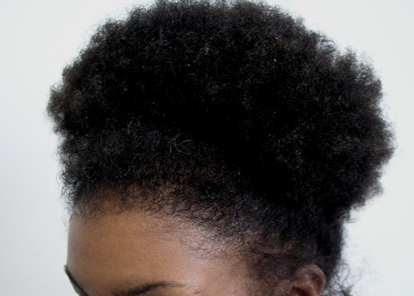 After Hair Restoration