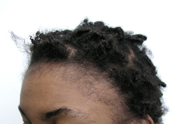 Before Hair Restoration