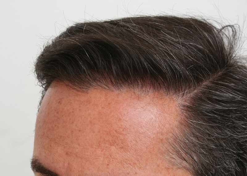 After hair restoration