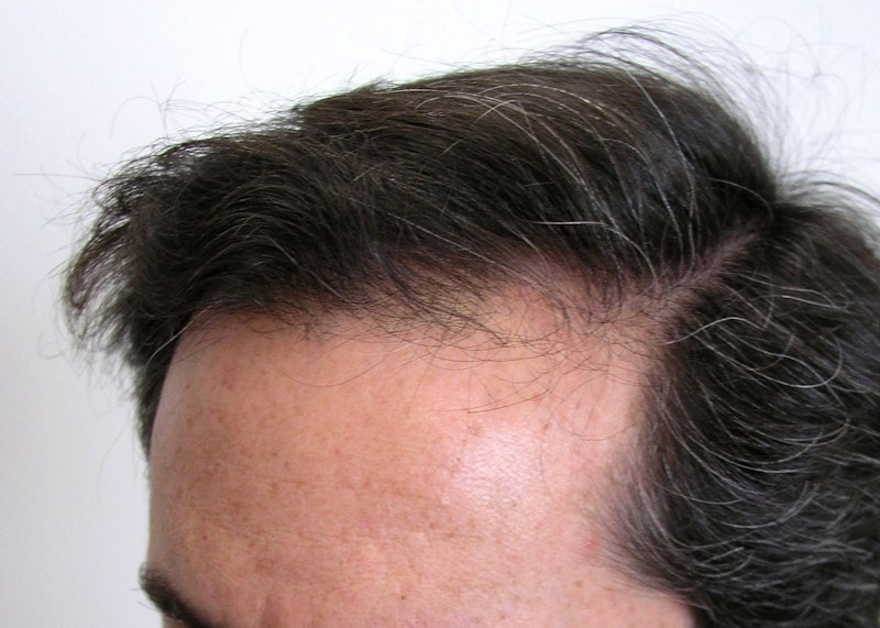 Before hair restoration