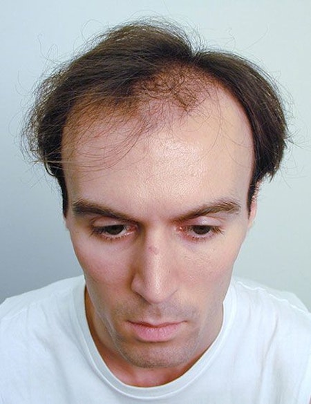 before hair restoration