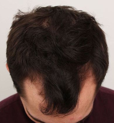 Hair Loss Doctors' Patient Before FUT