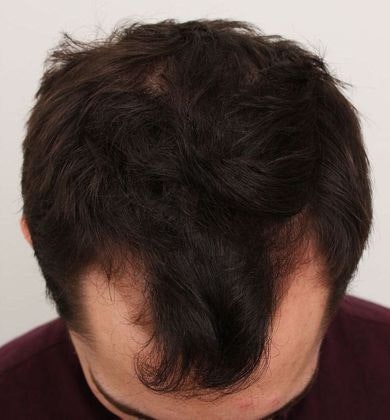 Hair Loss Doctors' Patient Before FUT