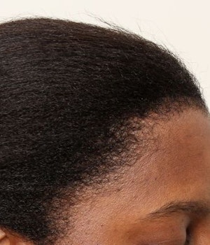After Traction Alopecia Restoration (FUT)