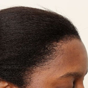 After Traction Alopecia Restoration (FUT)