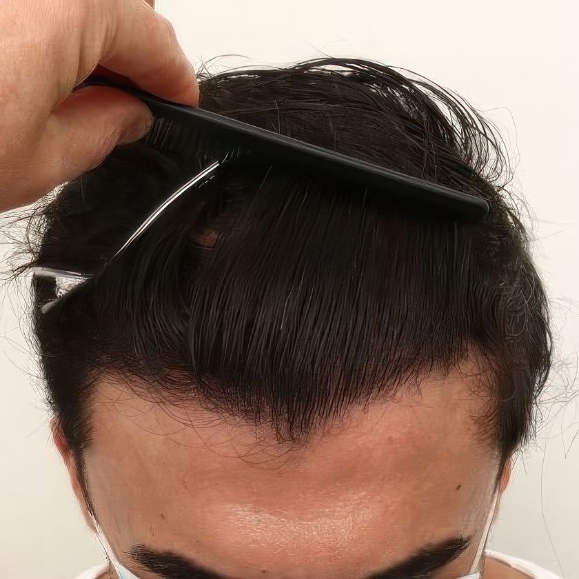 hair restoration result with comb running through hair