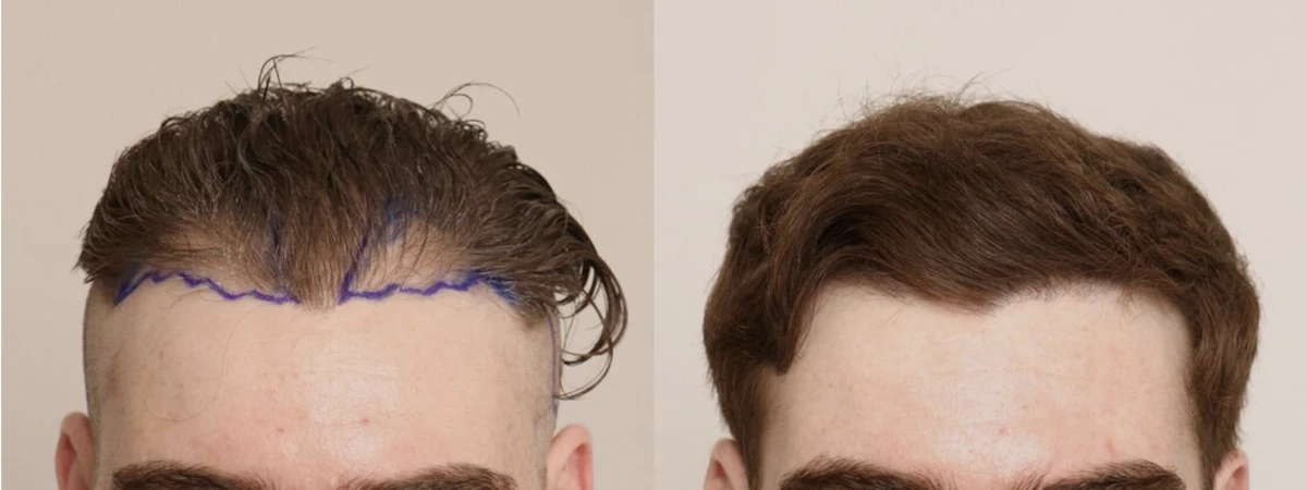 Hair restoration before and after — receding frontal hairline rebuilt, The Hair Loss Doctors