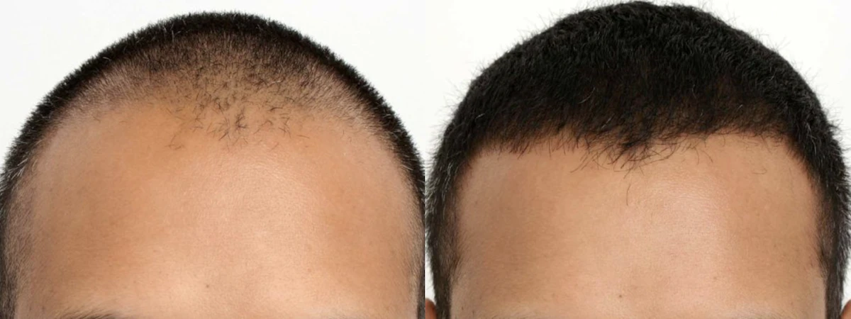 Hair restoration before and after — dense frontal hairline restored, The Hair Loss Doctors