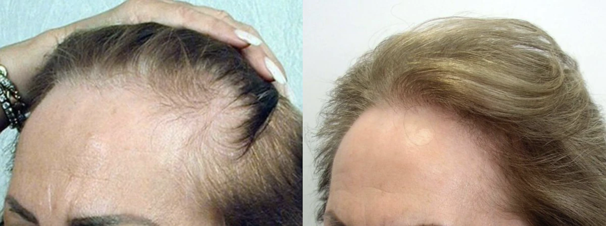 Hair restoration before and after — diffuse female-pattern thinning restored, The Hair Loss Doctors