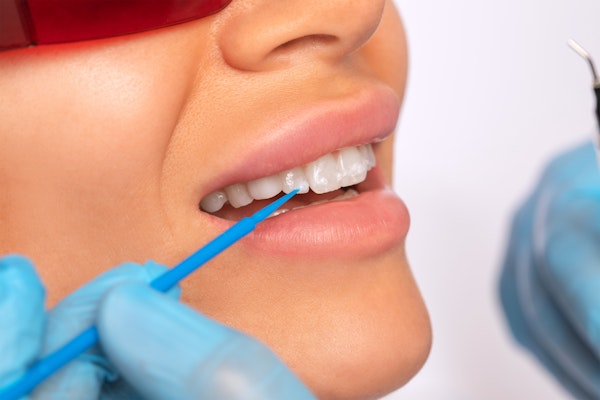 Dentist applying whitening treatment to a cosmetically flawed smile