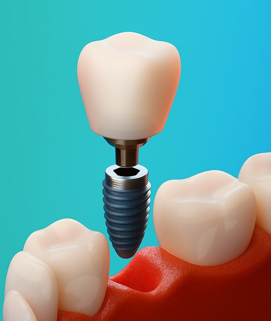 Implant crown