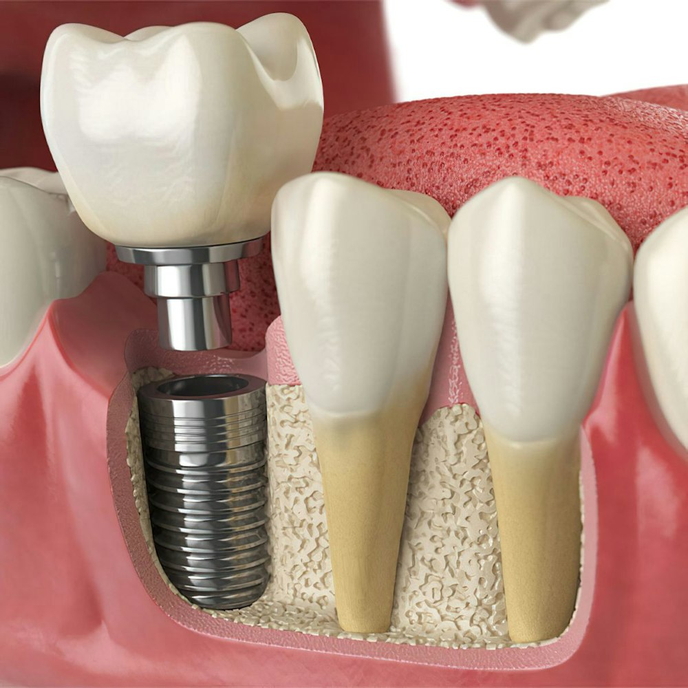 Dental implant