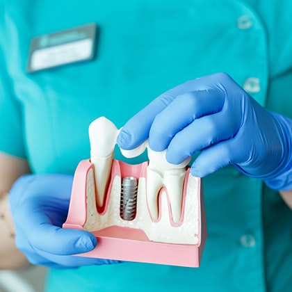 model of dental implants